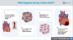 Infographic: what happens during a heart attack