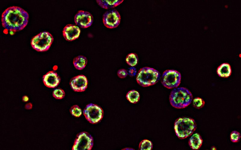 Airway organoids of Cystic Fibrosis patient