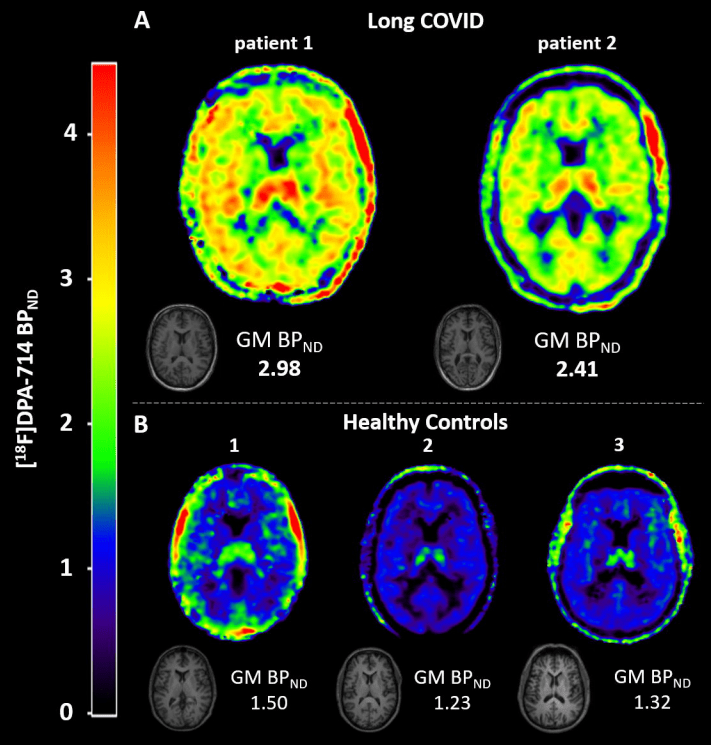 Brain scans showing brain inflammation in long covid