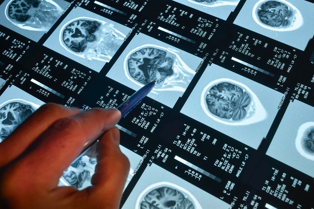 A hand pointing at a brain scan