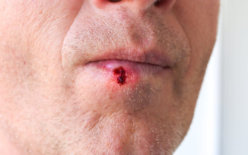 Picture of Herpes simplex on lips