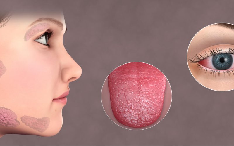 Illustration of the symptoms of Sjogren Syndrome