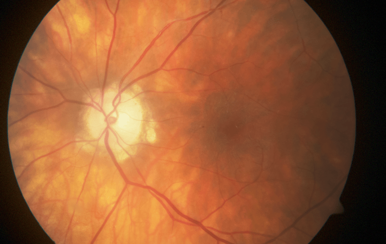 Picture of vessels in an eye