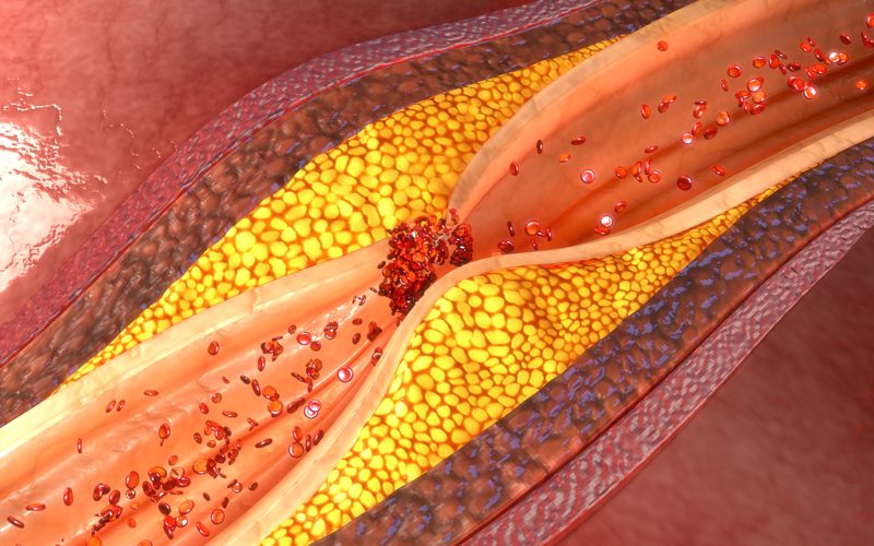 The arteries, which start out smooth and elastic, get plaque on their inner walls