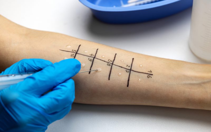 food allergy test on arm