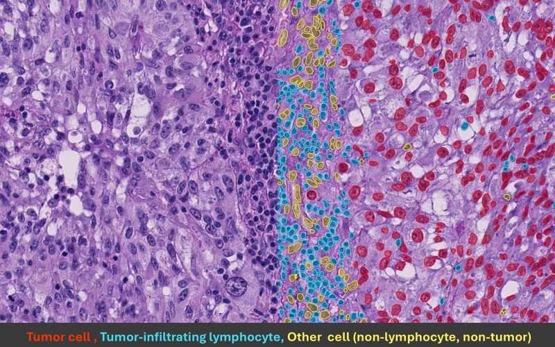Tumor infiltrating lymphocyes