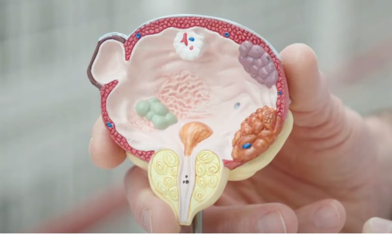Bladder Cancer